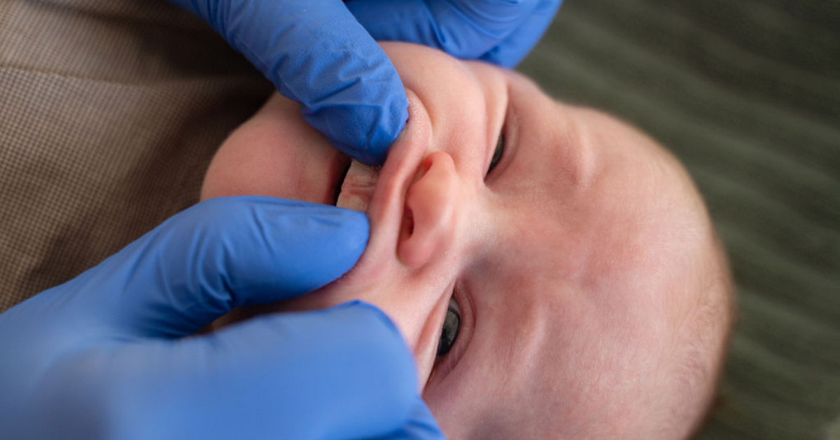 Terveydenhoitaja tutkii pienen vauvan huulijännettä.